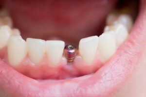 Benefits of Single-Tooth Dental Implants