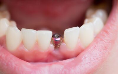 Benefits of Single-Tooth Dental Implants