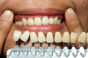 Enhancing your smile with veneers