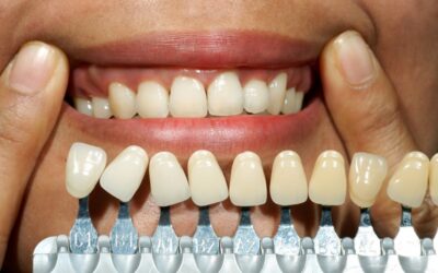 Enhancing Your Smile With Veneers