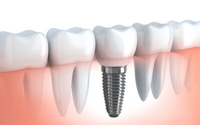 New Implant Approach