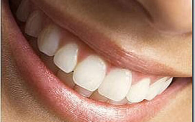 Fast and Easy Teeth Whitening with Teeth in One Day